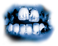 De giftige bestanddelen in meth leiden tot ernstig tandbederf dat bekendstaat als een “meth mond”. De tanden worden zwart, bevlekt, en beginnen te rotten, dikwijls zo erg dat ze getrokken moeten worden. De tanden en het tandvlees worden vernietigd van binnenuit en de wortels rotten weg.
